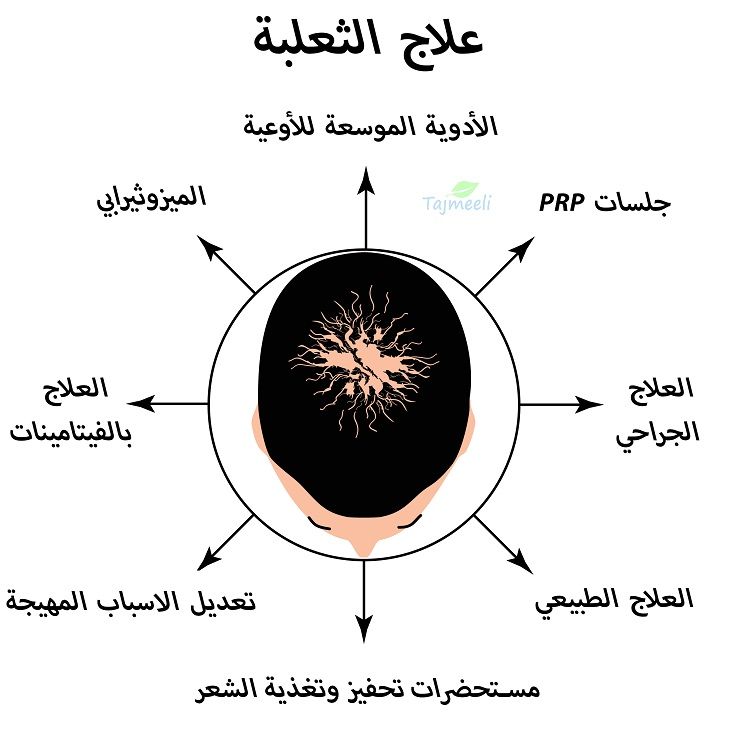 علاج الثعلبة