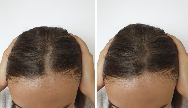 زراعة الشعر للنساء فى القاهرة