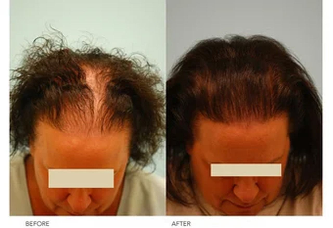 نتائج زراعة الشعر للنساء بالصور