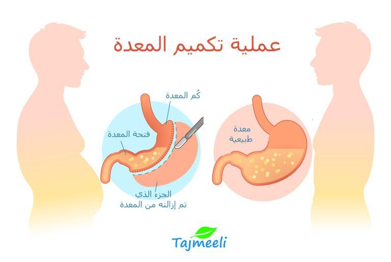 كيف تُجرىَ عمليتي تكميم المعدة وتحويل المسار؟