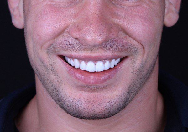 اضرار تركيب الاسنان