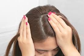 علاج صدفية الشعر