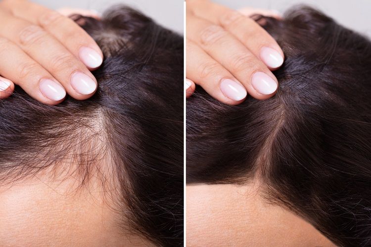 قبل وبعد زراعة الشعر بالليزر