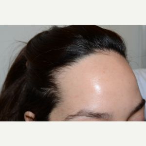 عملية تصغير الجبهة (forehead reduction)