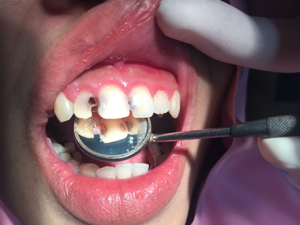 ⁨‎⁨الحالات التي يجب معالجتها قبل البدء في تجميل الأسنان بتقنية 3n ⁩⁩