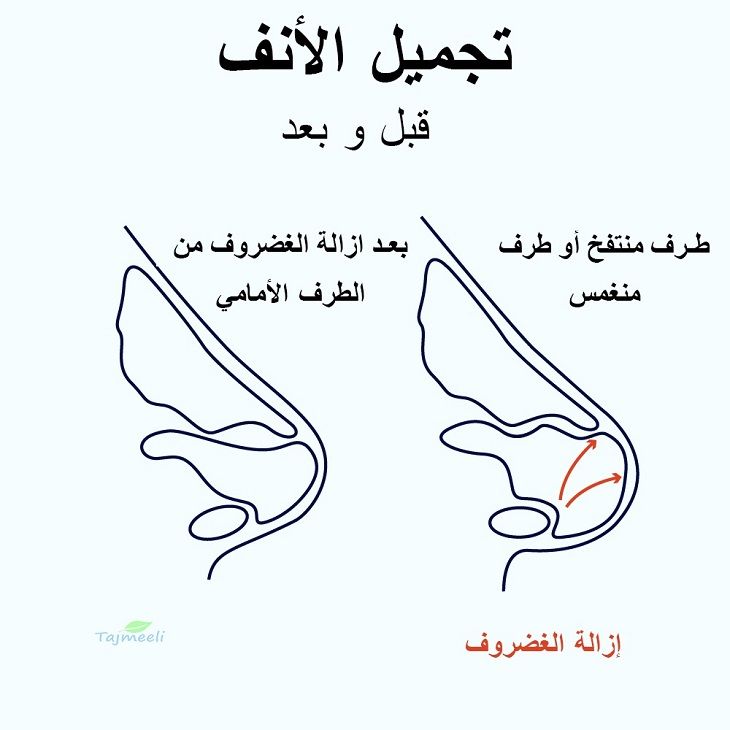 عمليات تجميل الأنف