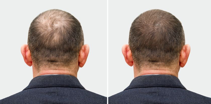 زراعة الشعر بالاقتطاف