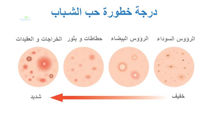 ⁨‎⁨حب الشباب ⁩⁩