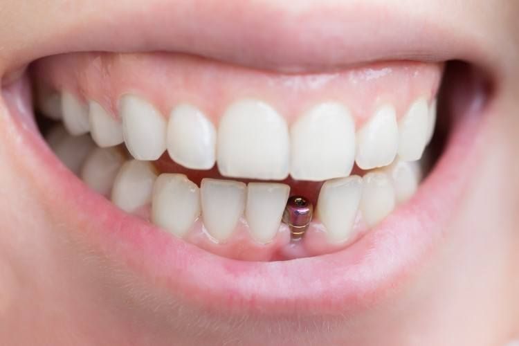 أهم العوامل التي تؤثر في تكلفة زراعة الأسنان