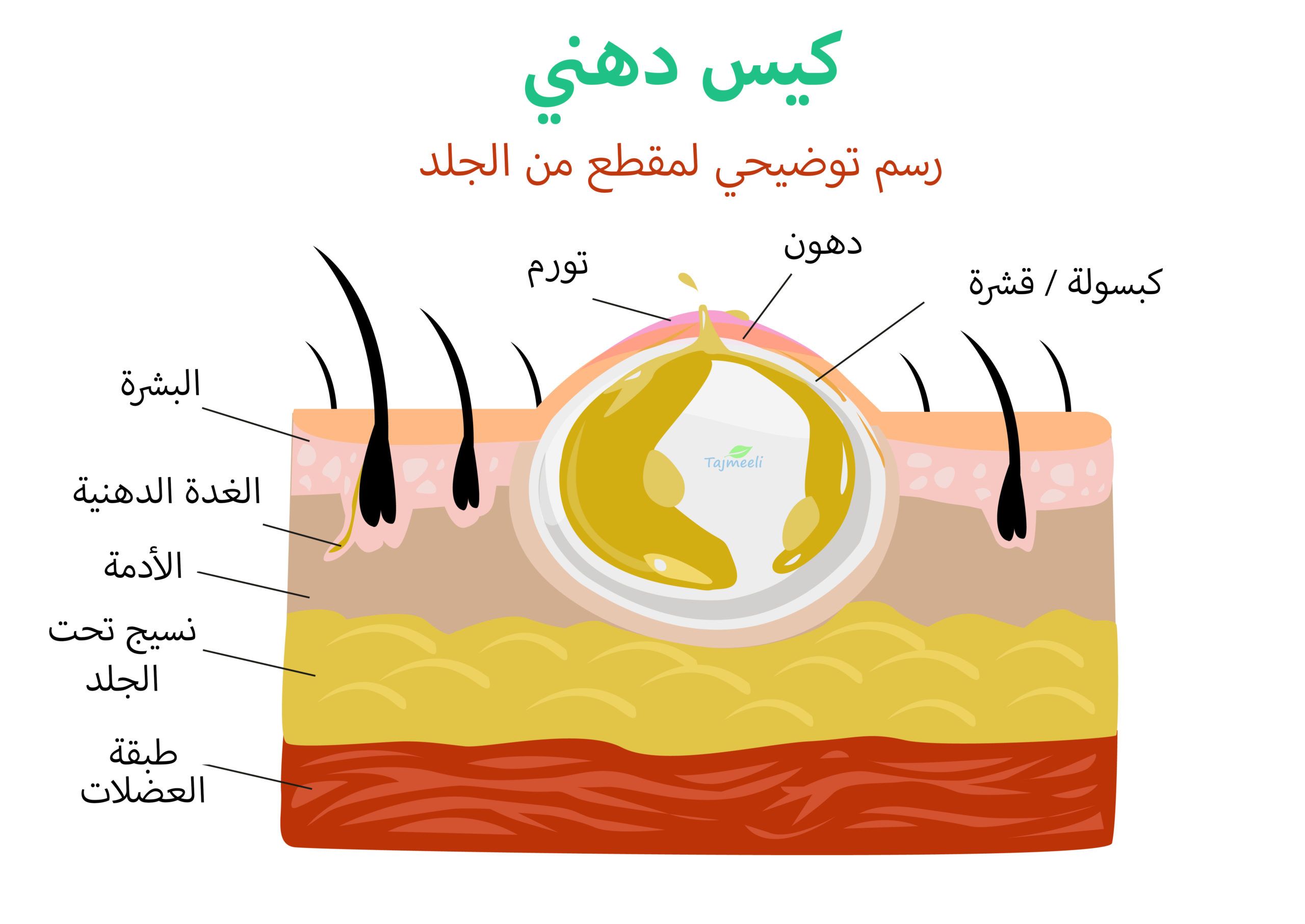 ما هو الكيس الدهني؟