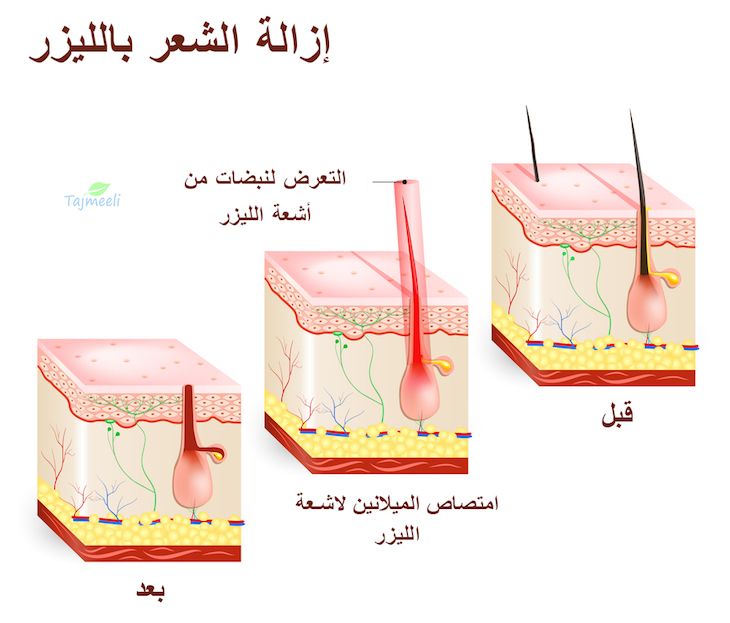 ⁨⁨‎⁨إزالة الشعر بالليزر⁩⁩⁩