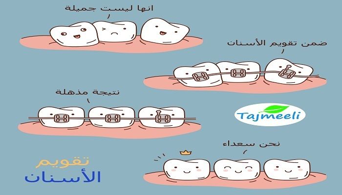 كم سعر تقويم الاسنان في مصر