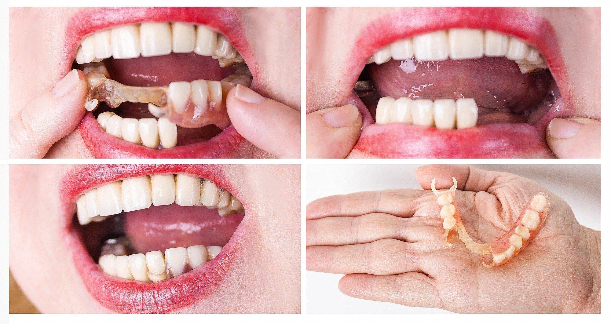 ⁨‎⁨ما هو جسر الأسنان⁩⁩