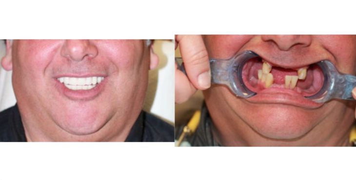 تجربة جسر الأسنان منذ 5 سنوات