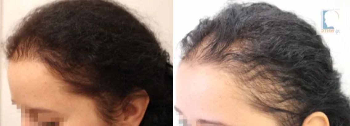 زيادة في طول الشعر بعد استخدام البيوتين