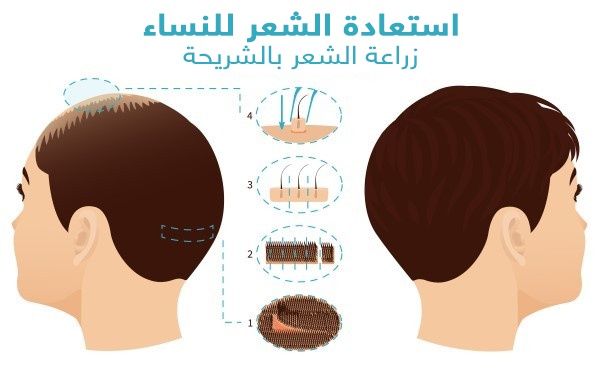 عملية زراعة شعر النساء في المغرب