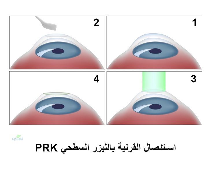 معلومات هامة حول اختيار أفضل مركز ليزك بدبي