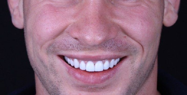 مميزات فينير الاسنان