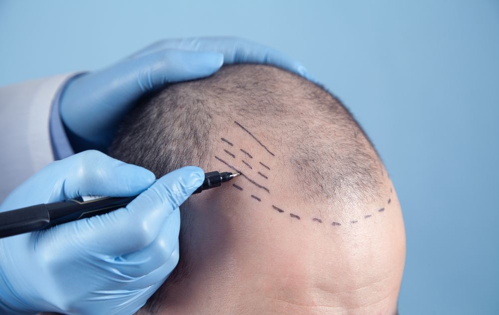 أبرز مراكز زراعة الشعر في طنطا