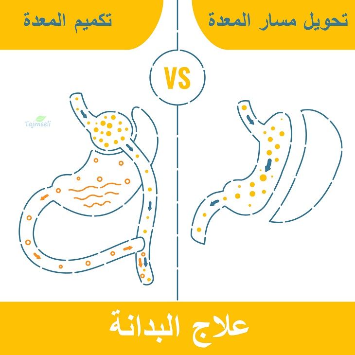 نبذة عن عمليات المعدة ودورها في إنقاص الوزن