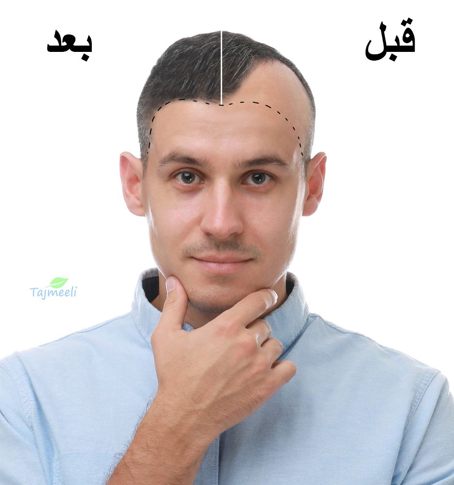 مميزات وعيوب عملية زراعة الشعر للرجال في مصر