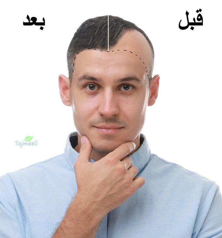 زراعة الشعر بالاقتطاف