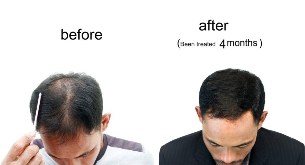  نتائج عملية زراعة الشعر الشهر الثالث