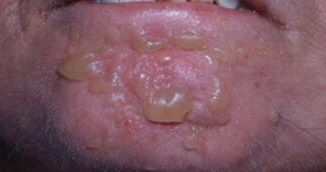أعراض مرض انحلال الجلد الفقاعي
