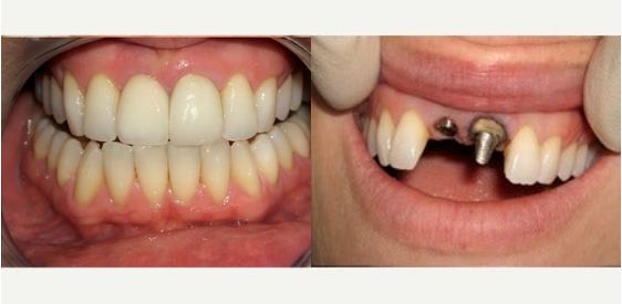 ⁨‎⁨نتائج زراعة الأسنان⁩⁩