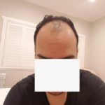 قبل وبعد زراعة الشعر