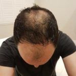 قبل وبعد زراعة الشعر