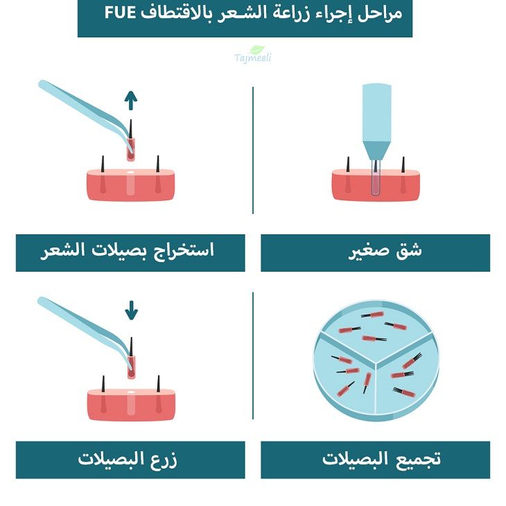 نبذة عن السعودية وزراعة الشعر بالتقسيط فيها