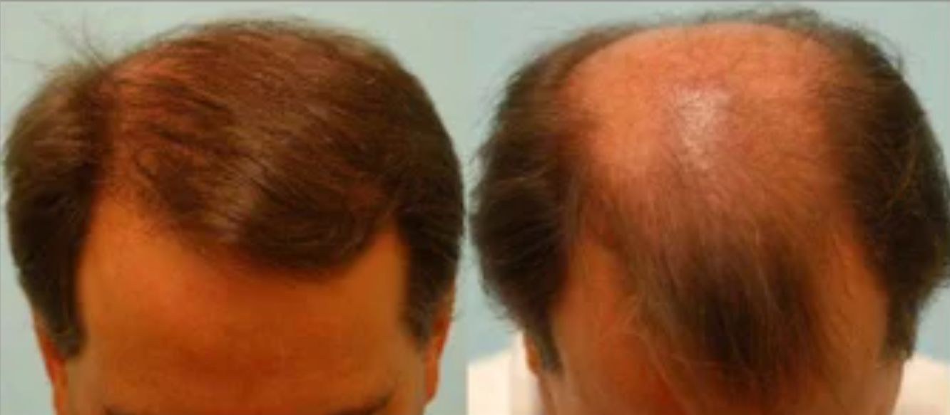 مميزات زراعة الشعر بالتقسيط بالسعودية