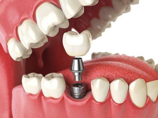  مراحل عملية تركيب الاسنان الثابتة