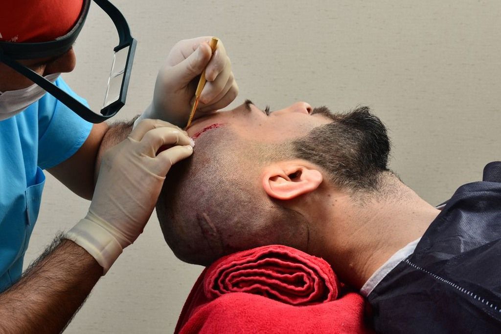 زراعة الشعر في الصيف