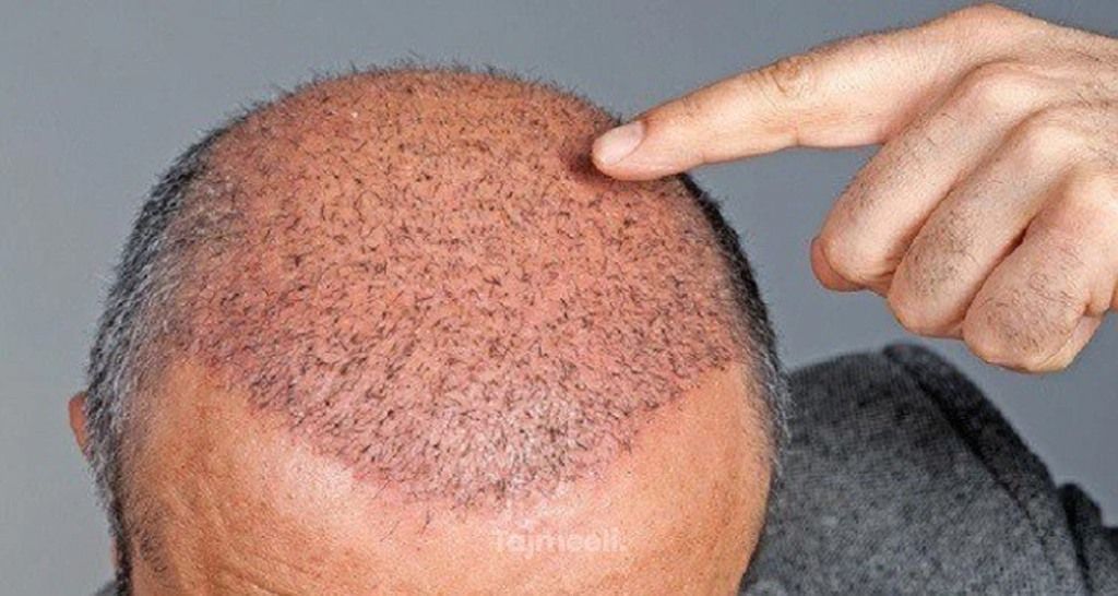 تأثير الحرارة على زراعة الشعر