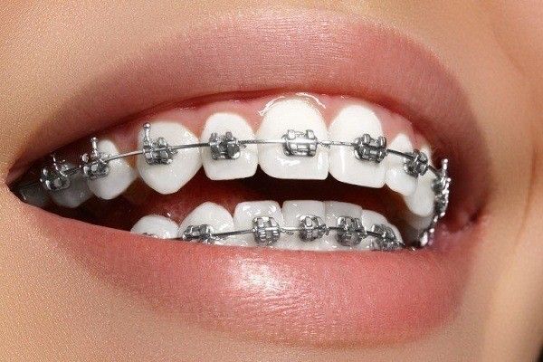 تقنية تقويم الأسنان لعلاج الابتسامة اللثوية