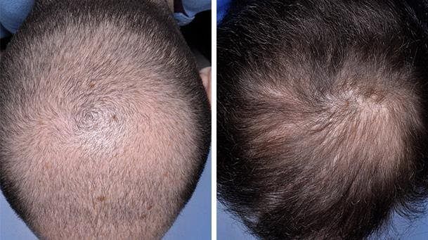 نتائج زراعة الشعر بعد أسبوعين