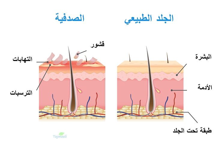 ⁨‎⁨الصدفية⁩⁩