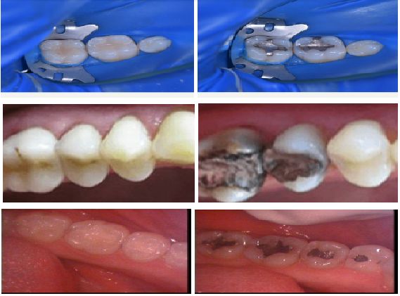 صور حشو الأسنان بالليزر قبل وبعد