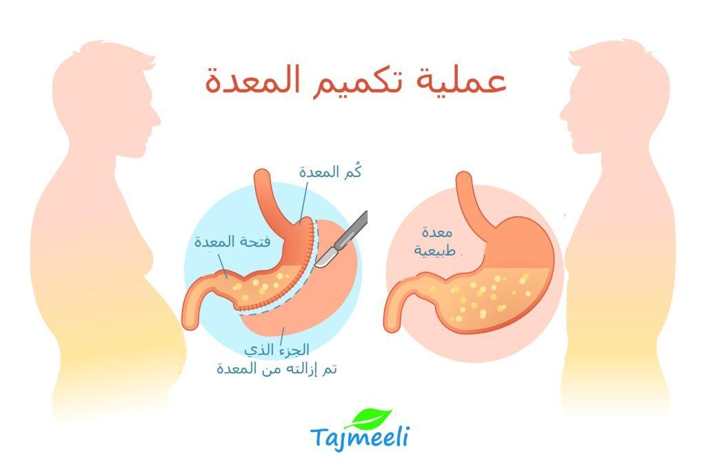 تكميم المعدة قبل وبعد