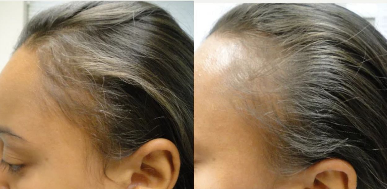 ⁨‎⁨تجارب استخدام زيت القطران في علاج مشاكل الشعر⁩⁩