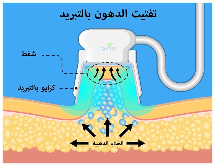 عملية شفط الدهون بالفيزر