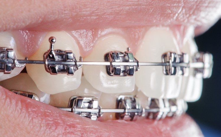علاج تفرق الاسنان بالتقويم الاسنان