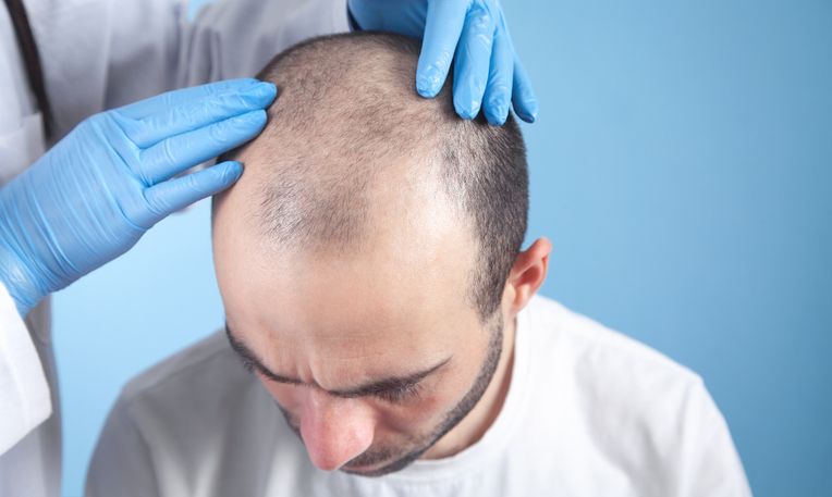 زراعة شعر مقدمة الرأس