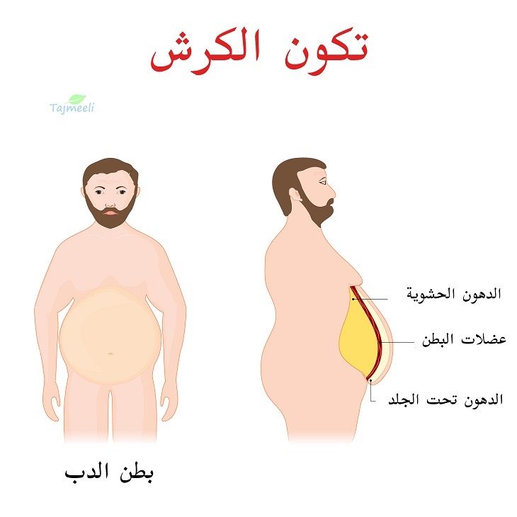 تكون الكرش ونحت الجسم بالتبريد