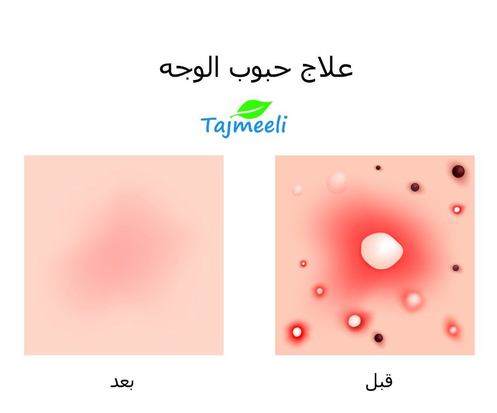 علاج حبوب الوجه