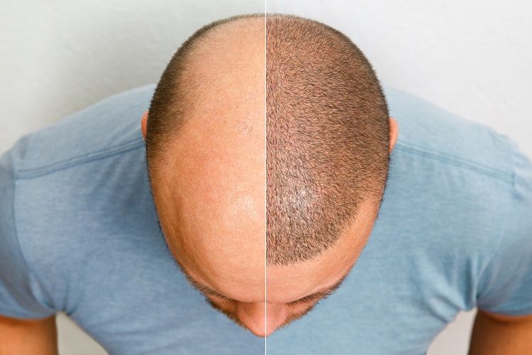 قبل وبعد زراعة الشعر