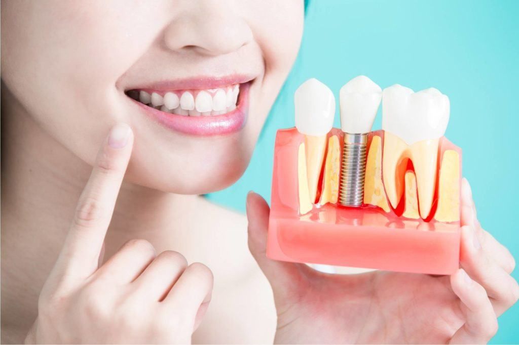  الإجراءات الإضافية المطلوبة لزرع الأسنان