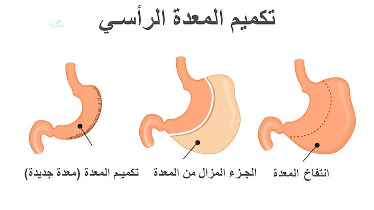 تكميم المعدة الرأسي⁩